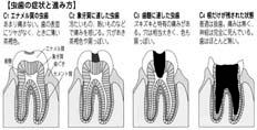 虫歯ができてしまう前に… シーラント！？