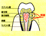 むし歯じゃないのに歯がしみる！？